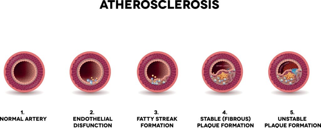 atherosclerosis