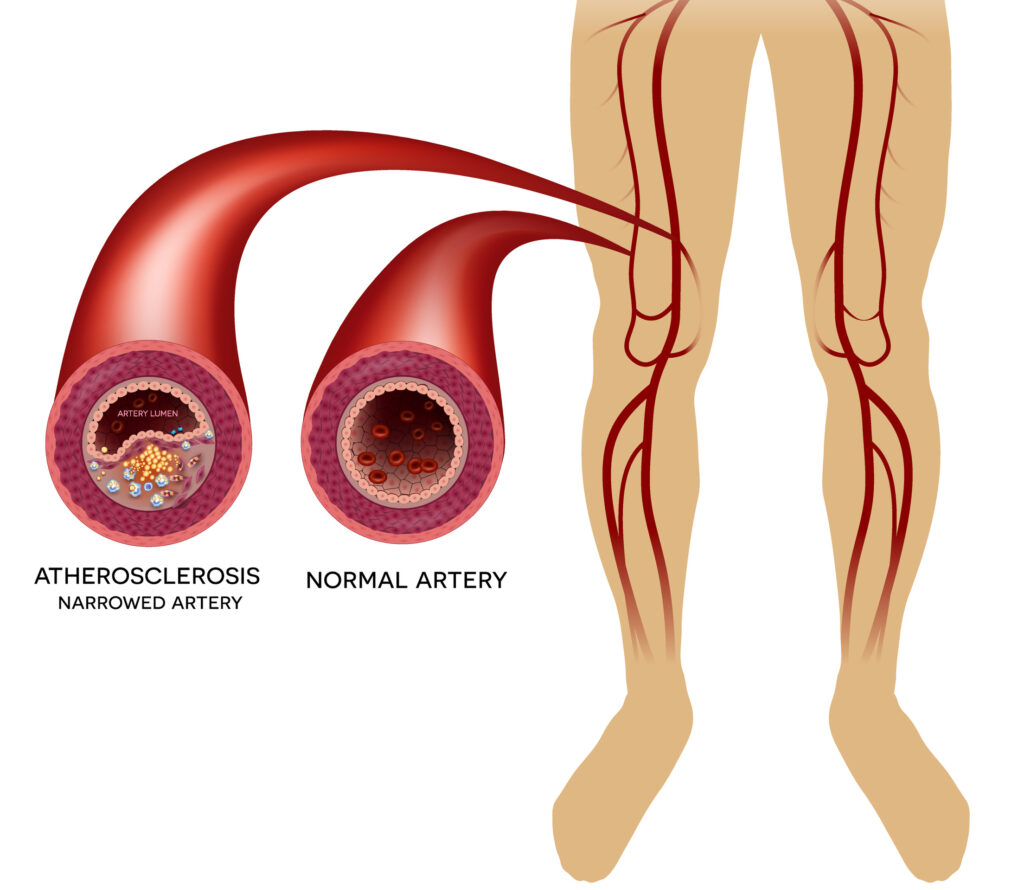 A diagram of blood vessels and veins